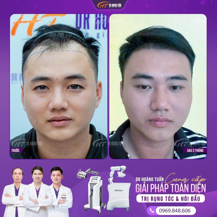 Cấy tóc trị hói do di truyền liệu có phải là giải pháp vĩnh viễn cho mái tóc?